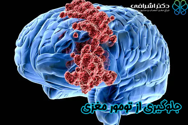 جلوگیری از تومور مغزی