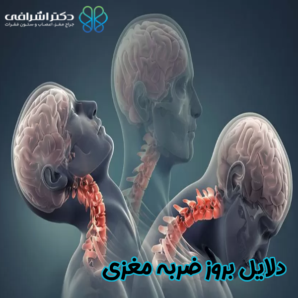 دلایل بروز ضربه مغزی