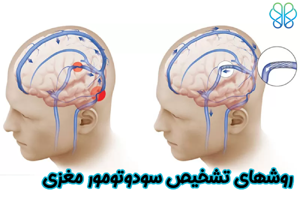 روشهای تشخیص سودوتومور مغزی