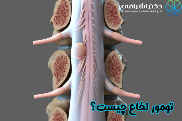 تومور نخاع چیست