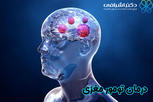 درمان تومور مغزی