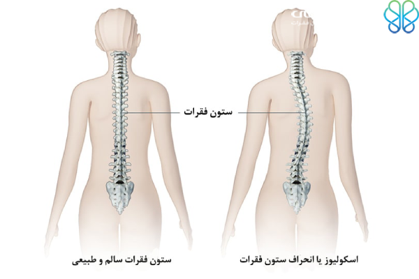 پیشگیری از انحراف ستون فقرات