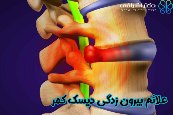 علائم بیرون زدگی دیسک کمر