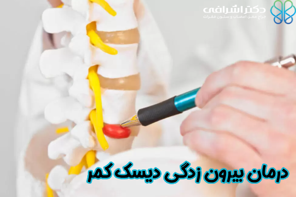 درمان بیرون زدگی دیسک کمر