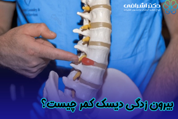 بیرون زدگی دیسک کمر چیست؟